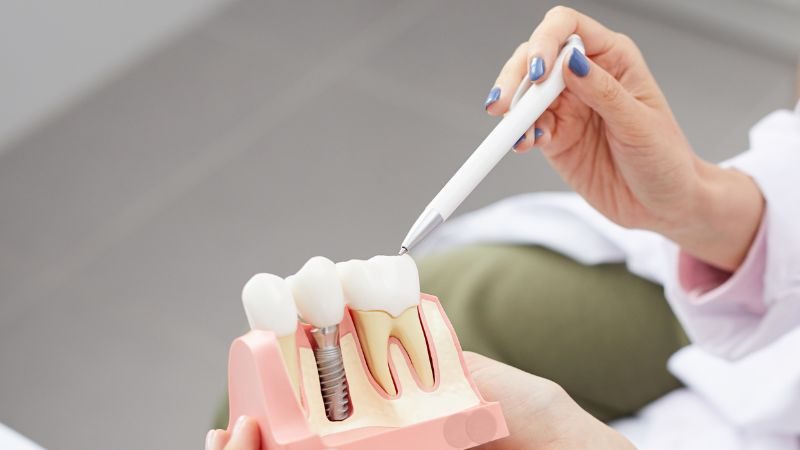 osteointegrazione su modello di impianto dentale