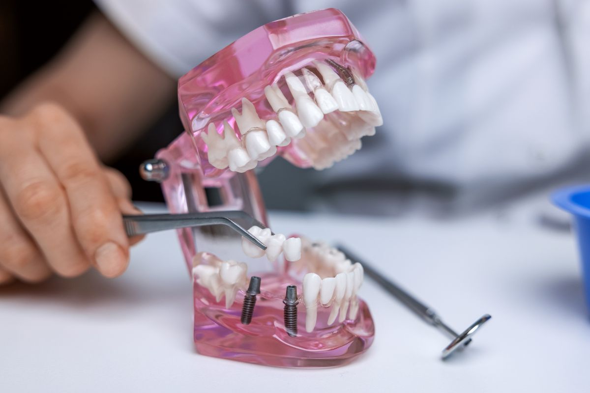 modello di impianto dentale