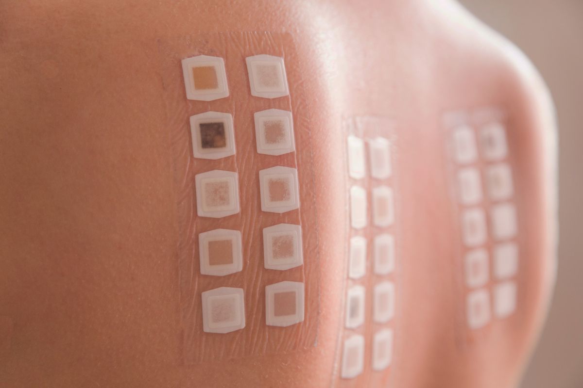 patch test per scoprire eventuale allergia ai metalli