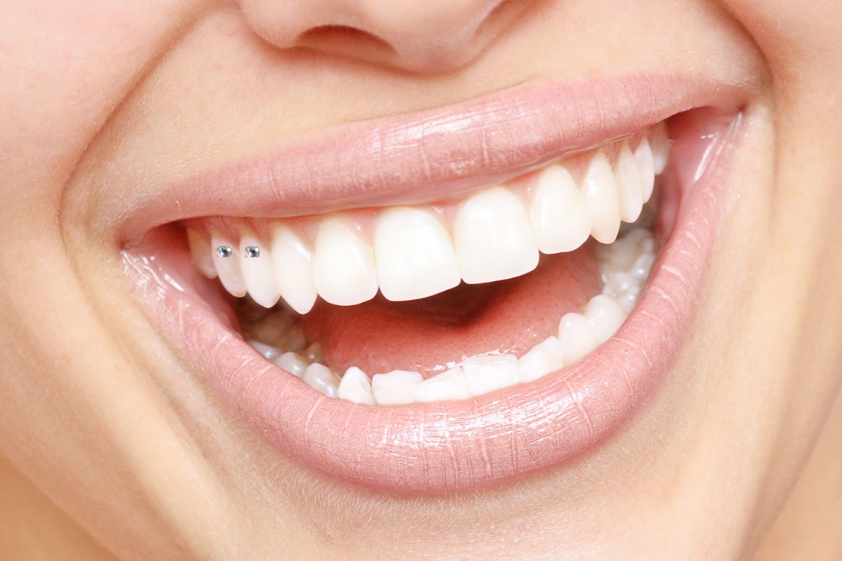 Primo piano del sorriso di una donna con due brillantini dentali applicati sui denti laterali superiori, risultato luminoso ed elegante.
