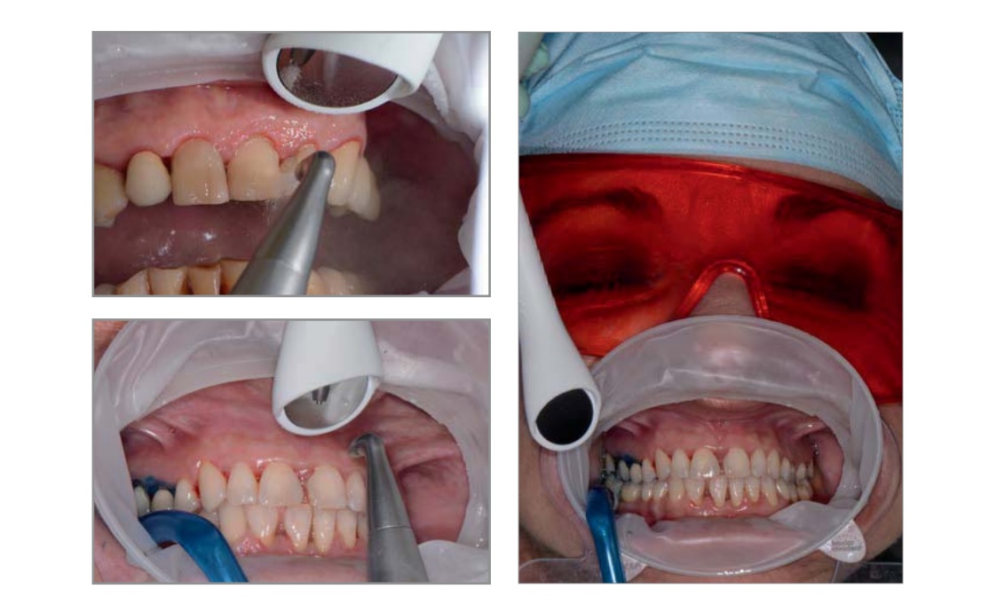 Seduta di igiene orale con ablatore Mectron: rimozione delicata di placca e tartaro con tecnologia ad ultrasuoni e polveri Mectron prophylaxis powder e glycinepowder