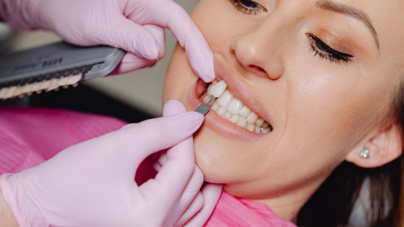 Visione macro dell'applicazione di una faccetta dentale su un incisivo, mostrando precisione e adattamento anatomico