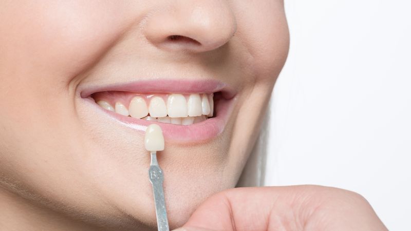 faccetta dentale