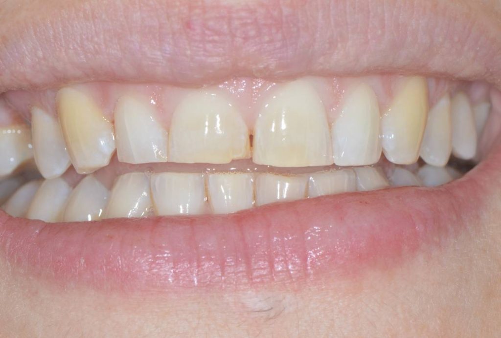 Dentatura naturale con discromie e spazio interdentale: denti anteriori superiori giallognoli, con usura marginale e lieve diastema centrale.