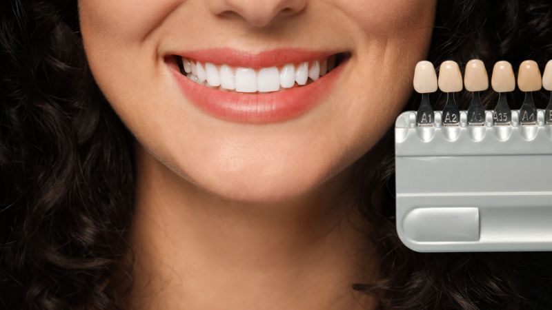 Dettaglio ravvicinato di una serie di faccette dentali in ceramica pronte per l'applicazione, disposte su superficie neutra.