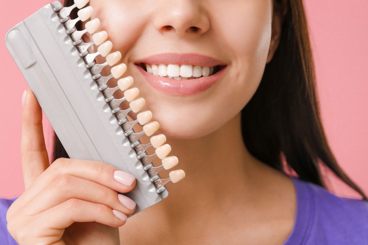 Inquadratura estetica del sorriso di una donna con faccette dentali appena applicate, in un contesto professionale.