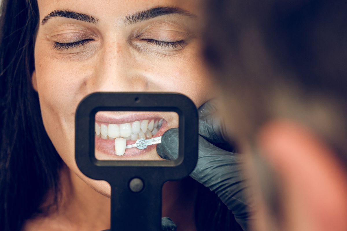 Panoramica laterale dell’arcata superiore con faccette dentali, evidenziando uniformità di forma e brillantezza