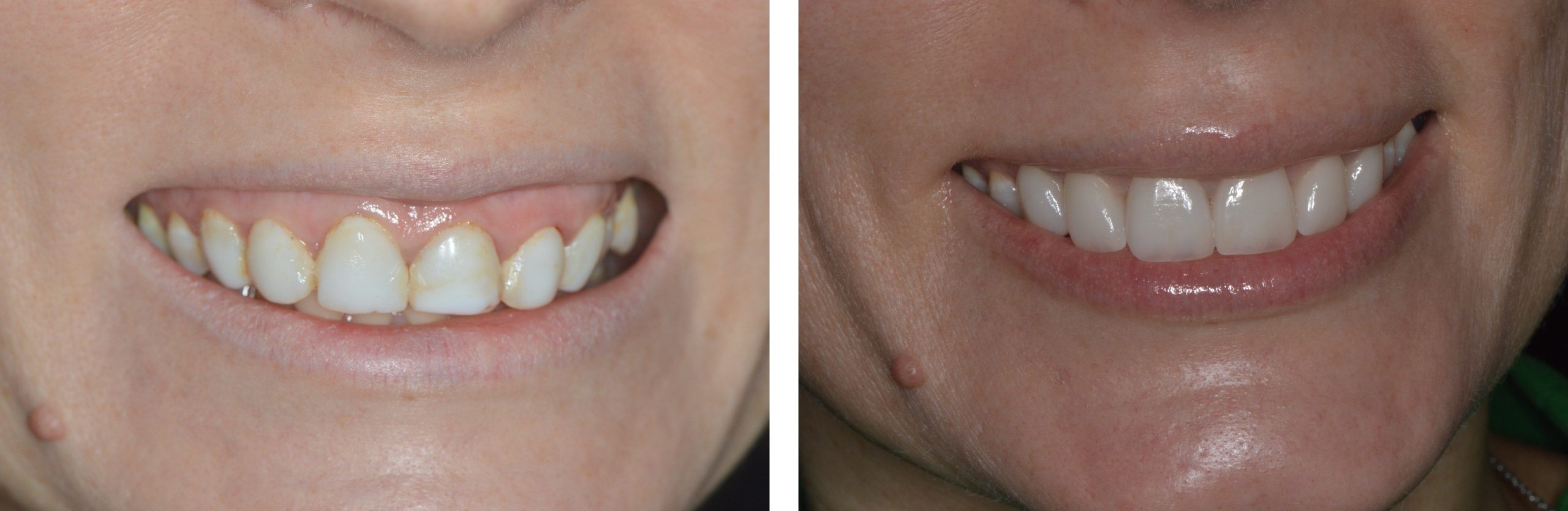 Sorriso di una paziente prima e dopo l'applicazione di faccette dentali in ceramica: a sinistra, denti consumati e pigmentati; a destra, dentatura uniforme, brillante e armonizzata grazie al trattamento estetico effettuato in studio dentistico.
