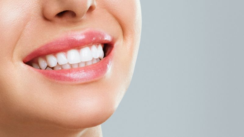 Denti bianchi perfetti dopo sbiancamento professionale – sorriso luminoso