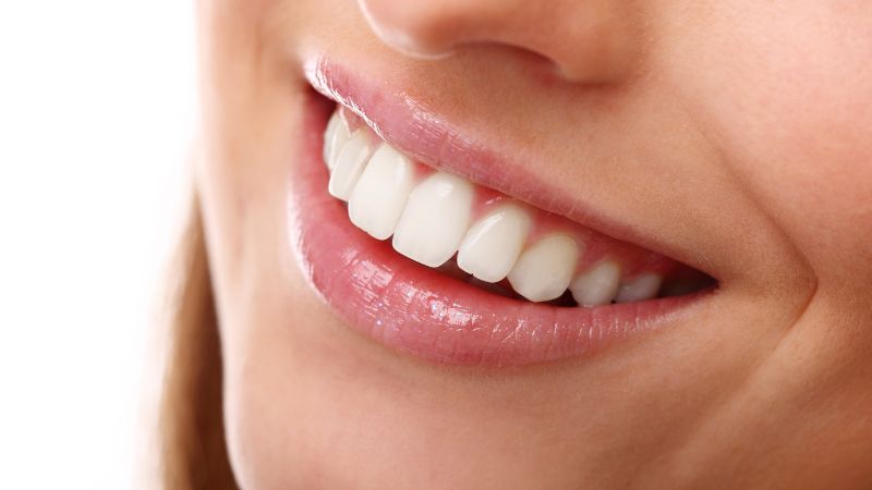 Sorriso con denti bianchi naturali dopo trattamento di sbiancamento