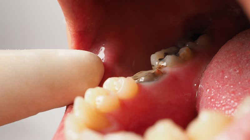 esempio di dente devitalizzato nero prima dello sbiancamento