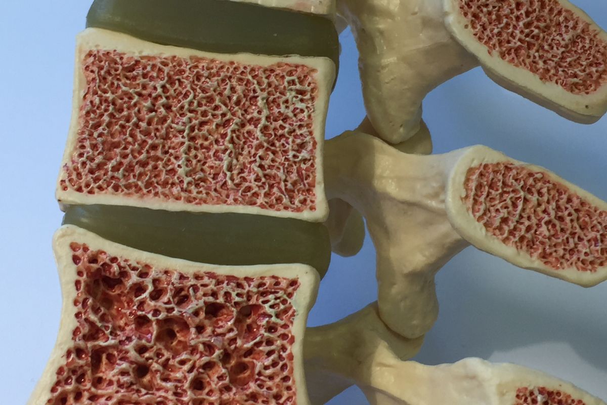 osteoporosi