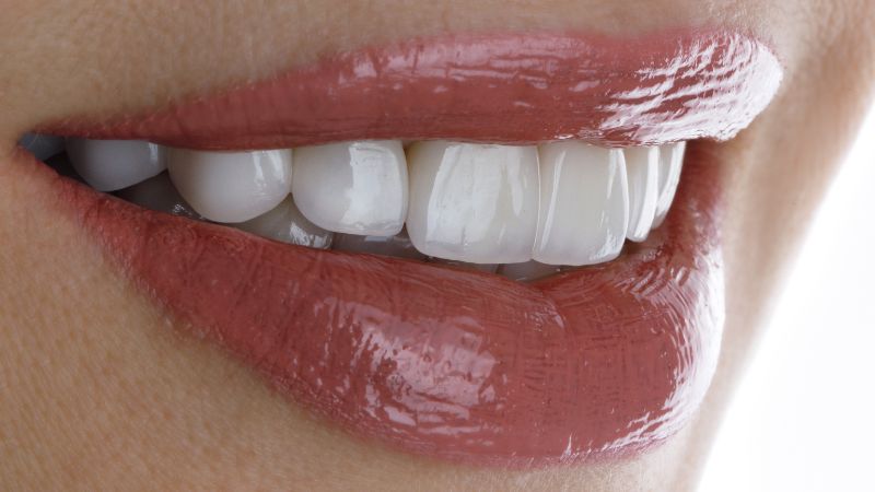 denti bianchi post mockup faccette dentali