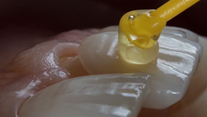 faccetta dentale posata su dente