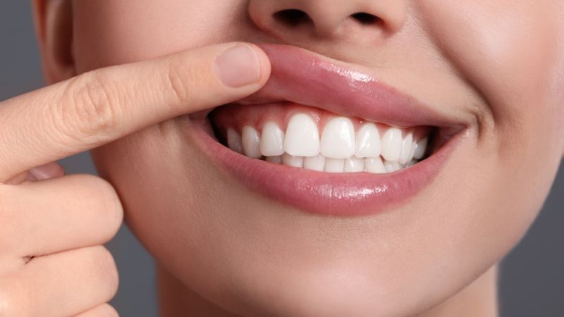 gengive sane e faccette dentali