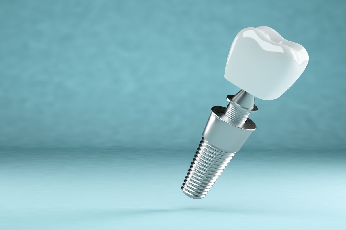 Illustrazione 3D di un impianto dentale completo, con la vite in titanio e la corona bianca. Rappresenta il tipo di dispositivo medico la cui compatibilità con la risonanza magnetica viene valutata