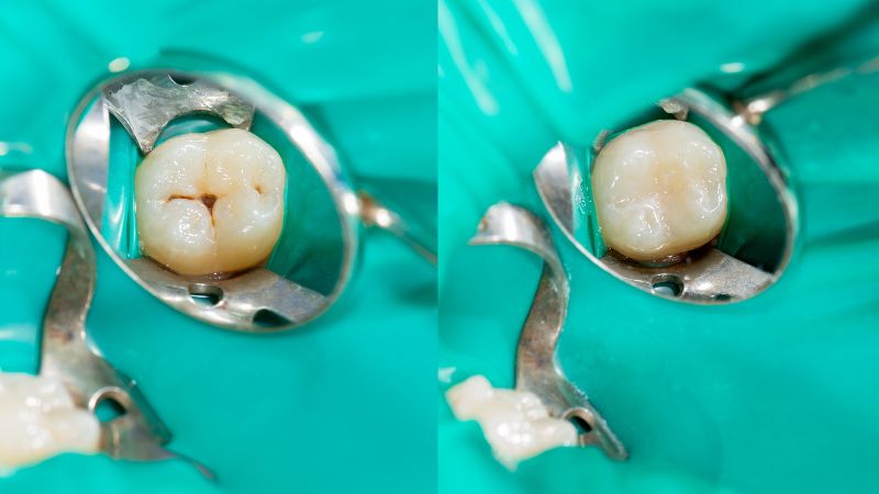 Confronto "prima e dopo" di una sigillatura dentale: a sinistra il dente molare con i solchi scuri e a rischio carie, a destra lo stesso dente con i solchi riempiti e protetti dal sigillante bianco.