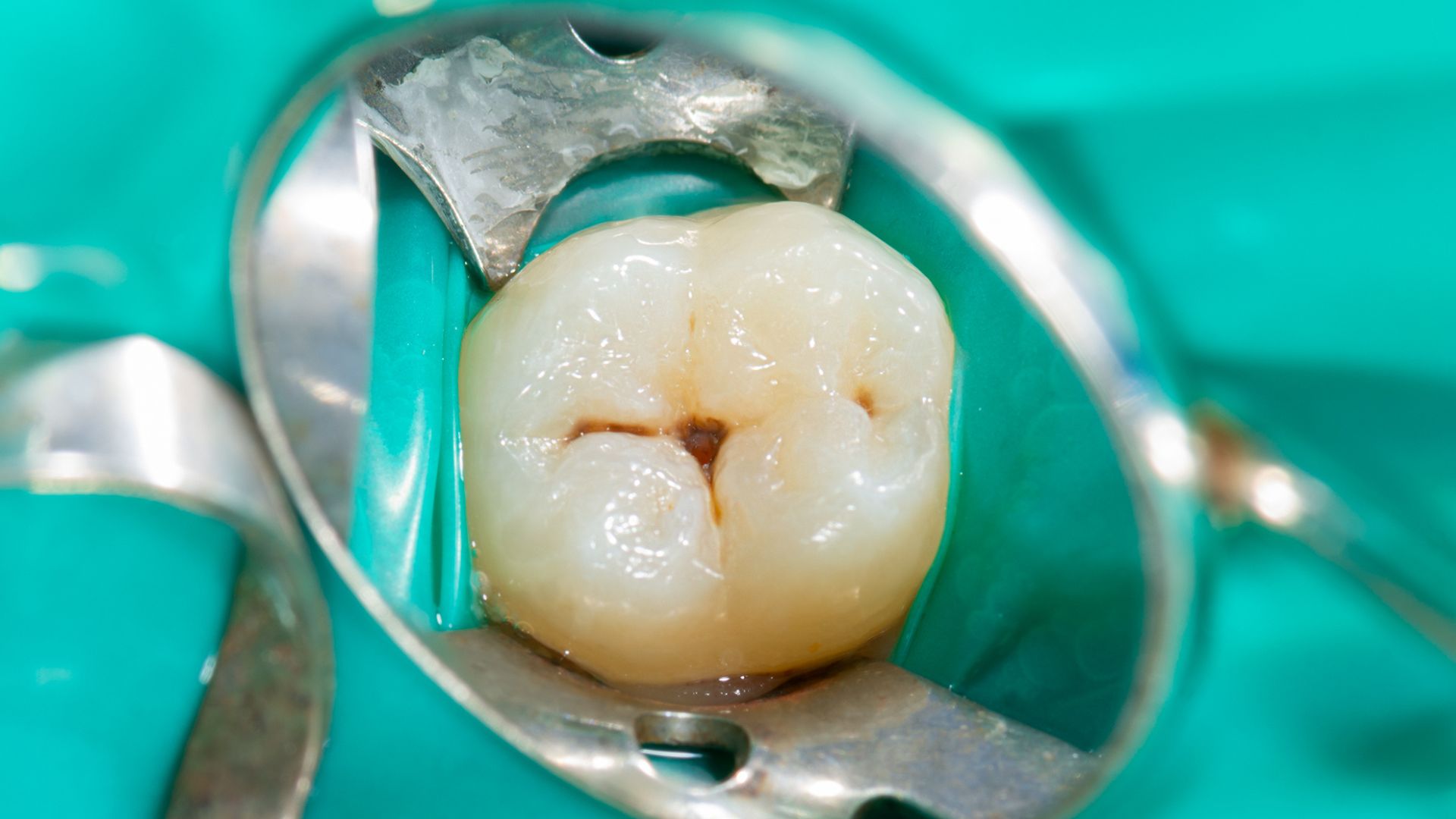 Un dente molare visto da vicino, isolato da una diga dentale verde, che mostra un solco profondo e scuro sulla superficie masticatoria, indicazione per un trattamento di sigillatura preventiva
