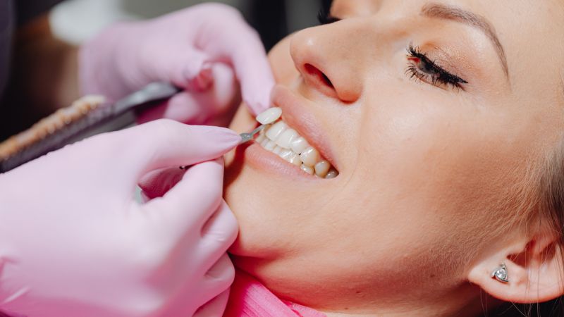 immagine nella quale vediamo come si applicano le faccette dentali su una paziente