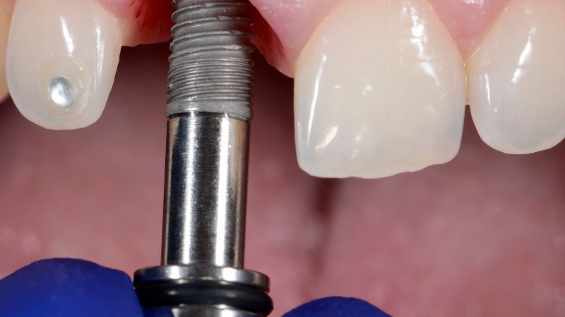 impianto dentale provvisorio