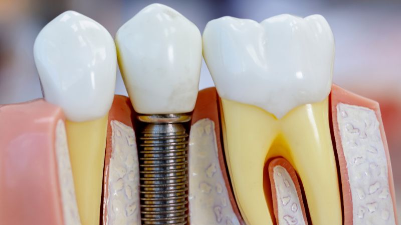 impianti dentali, la cui durata dipende anche molto dal tipo di materiale e manutenzione
