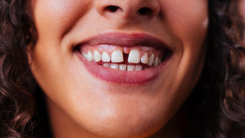 diastema in ragazza che con uso di faccette dentali può esteticamente risolvere