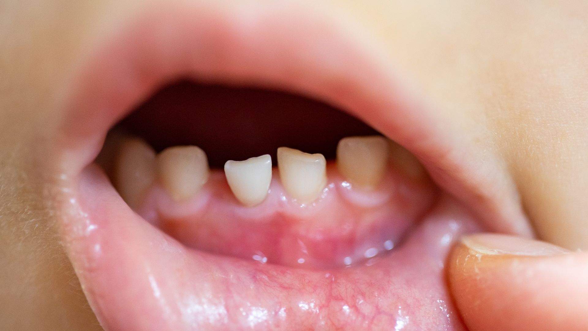 dentizione in bambini